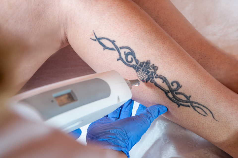 Rimozione tatuaggi con il laser