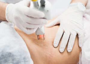 chirurgia laser