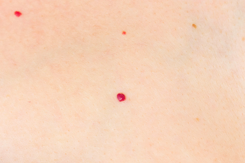 Angiomi 1 Laserterapia Angiomi Firenze Centro Medico Europa