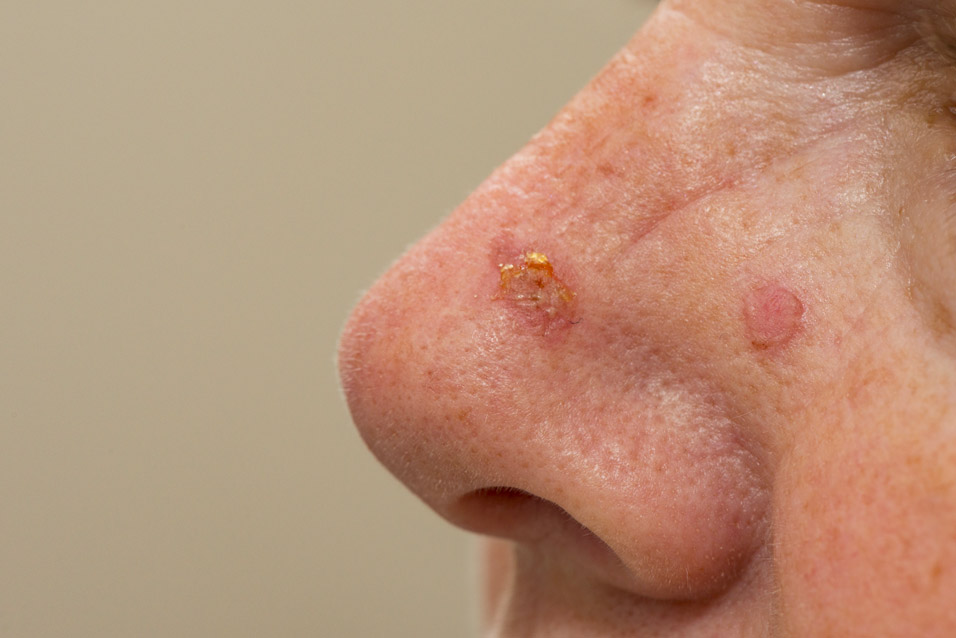 Laserterapia cheratosi firenze centro medico europa