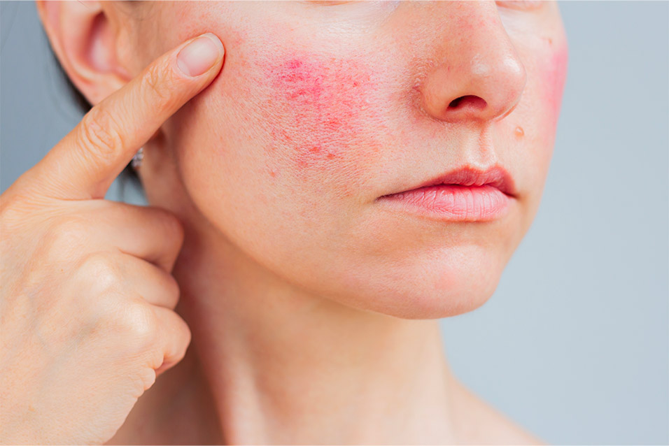 Rosacea 1 Rosacea Centro Medico Europa