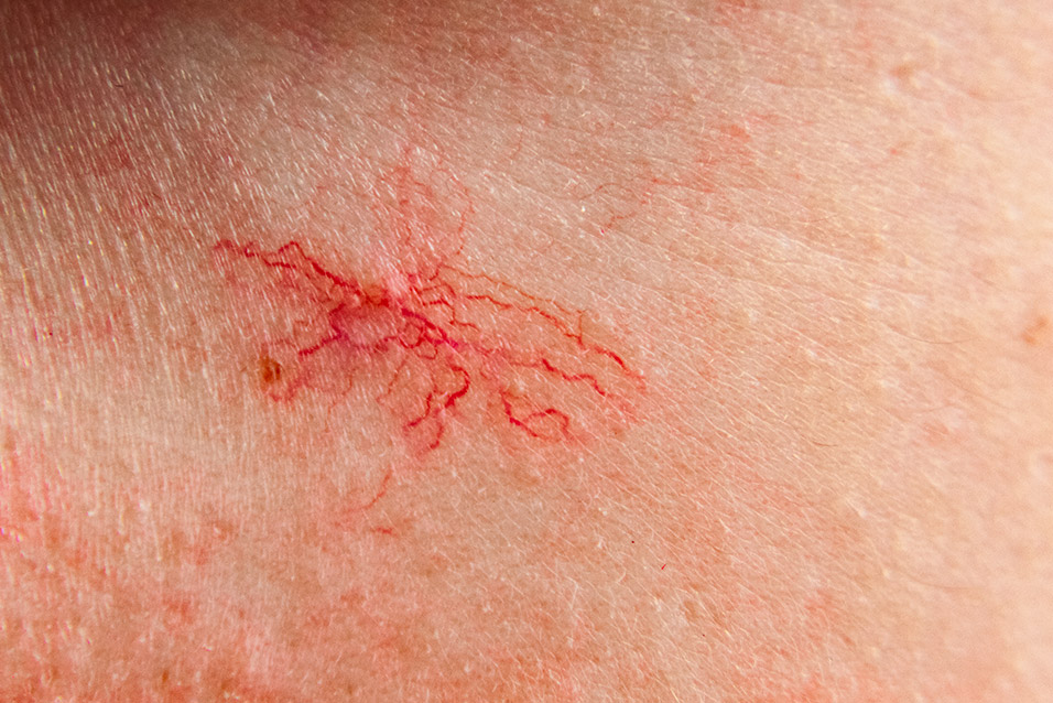 Spider nevus 1 Spider nevus Centro Medico Europa